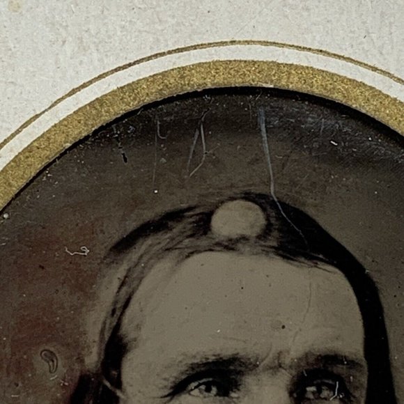 1880’s Skull Base Tumor On Mans Head Medical Daguerreotype photograph Golf Ball! - Picture 3 of 4
